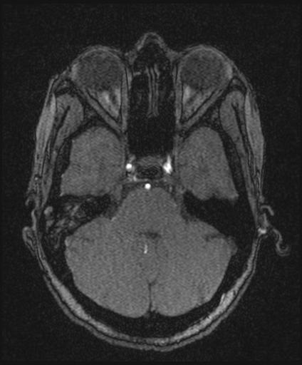 Bilateral carotid body tumors and right glomus jugulare tumor (Radiopaedia 20024-20060 Axial MRA 51).jpg