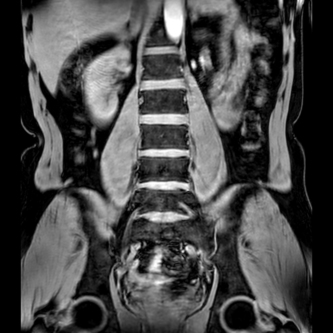 Bilateral conjoined nerve roots at different levels (Radiopaedia 73312-84063 Coronal WE 23).jpg