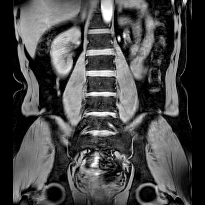 Bilateral conjoined nerve roots at different levels (Radiopaedia 73312-84063 Coronal WE 24).jpg