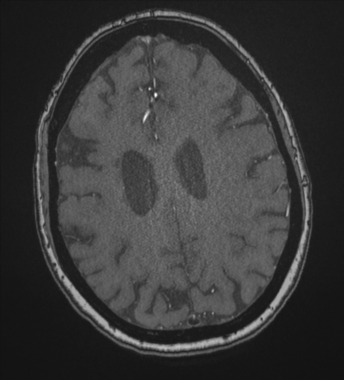 Bilateral fetal posterior communicating arteries (Radiopaedia 41286-44102 Axial MRA 161).png