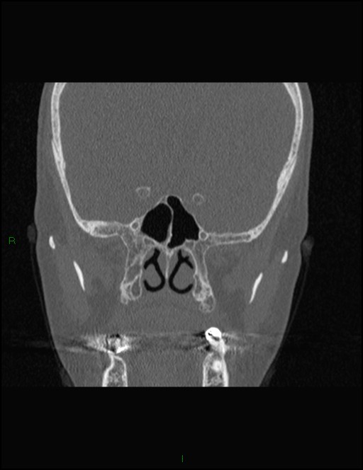 Bilateral frontal mucoceles (Radiopaedia 82352-96454 Coronal 209).jpg