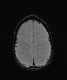 Bilateral mesial temporal polymicrogyria (Radiopaedia 76456-88181 Axial SWI 58).jpg