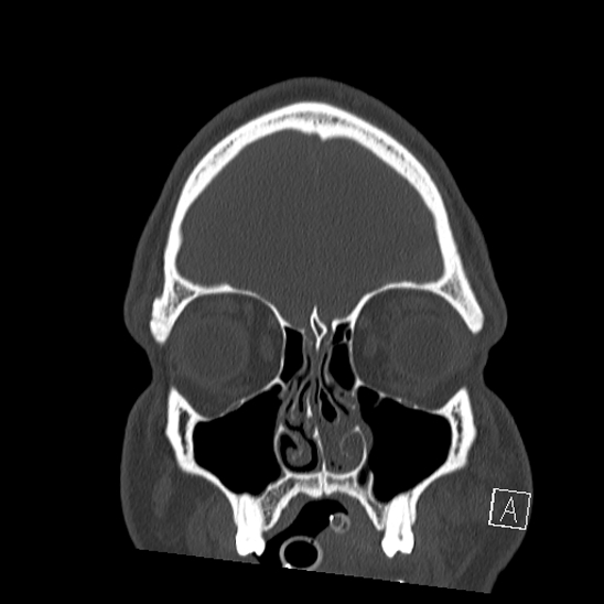 Bilateral occipital condyle fracture (type 2) (Radiopaedia 87675-104089 Coronal bone window 8).jpg