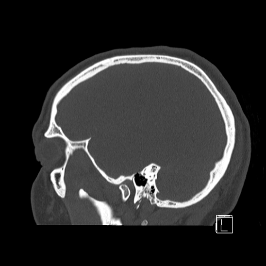 Bilateral occipital condyle fracture (type 2) (Radiopaedia 87675-104089 Sagittal bone window 15).jpg