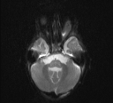 File:Bilateral optic pathway gliomas (Radiopaedia 40013-42514 Axial DWI 2).jpg