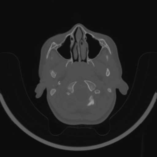 Bilateral otosclerosis (Radiopaedia 57237-64157 C 5).jpg
