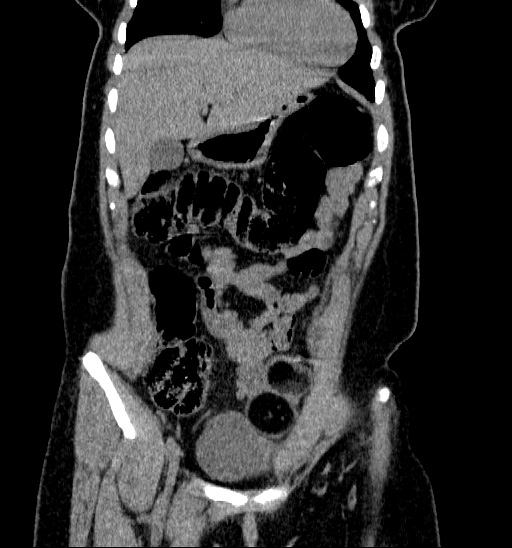 File:Bilateral ovarian dermoid (Radiopaedia 45714-49907 Coronal non-contrast 4).jpg