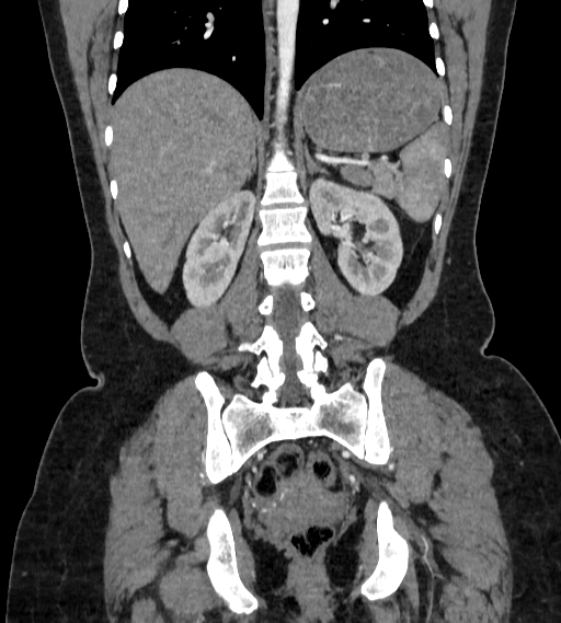 File:Bilateral ovarian mature cystic teratomas (Radiopaedia 79373-92457 B 63).jpg
