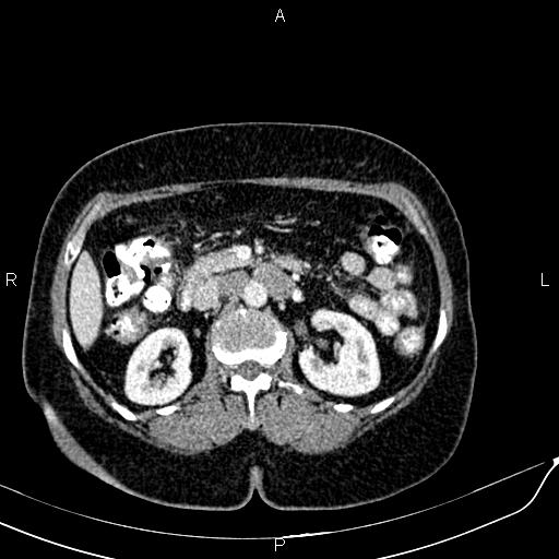 Bilateral ovarian serous cystadenocarcinoma (Radiopaedia 86062-101989 B 40).jpg