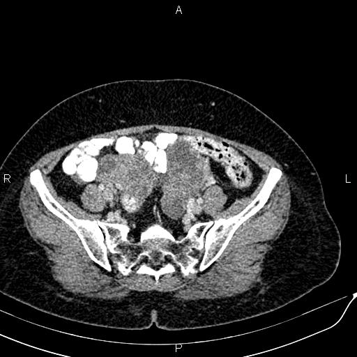 Bilateral ovarian serous cystadenocarcinoma (Radiopaedia 86062-101989 B 79).jpg