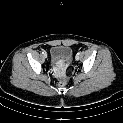 Bilateral ovarian teratoma (Radiopaedia 83131-97503 Axial With contrast 50).jpg