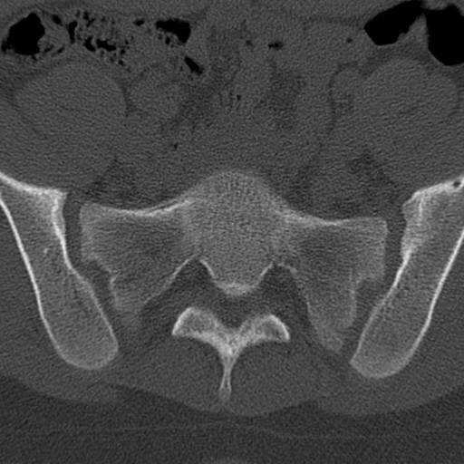 File:Bilateral pars defect (Radiopaedia 26691-26846 Axial bone window 87).jpg