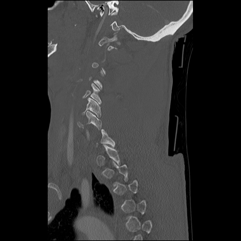 Bilateral perched facets with cord injury (Radiopaedia 45587-49713 Sagittal bone window 39).jpg