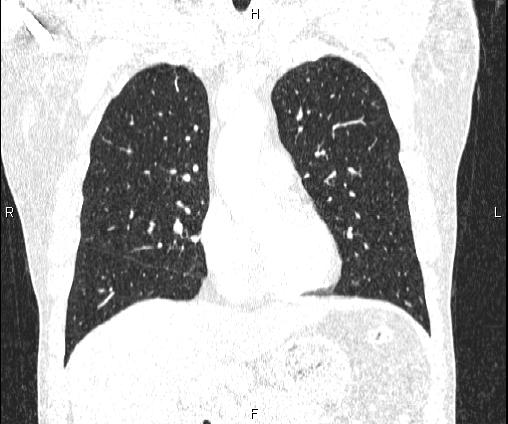 Bilateral pulmonary AVM (Radiopaedia 83134-97505 Coronal lung window 35).jpg
