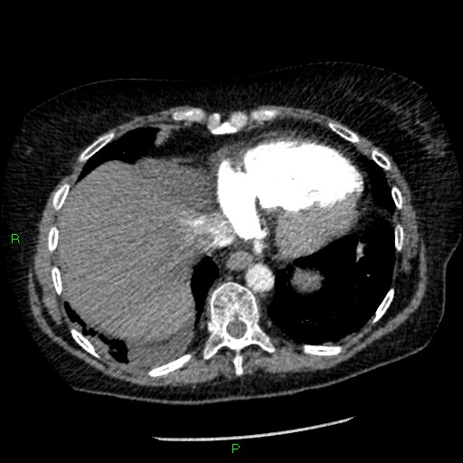 Bilateral pulmonary emboli (Radiopaedia 32700-33669 Axial C+ CTPA 87).jpg