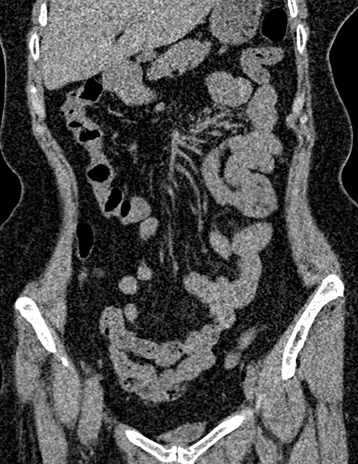 Bilateral staghorn calculi (Radiopaedia 59475-66842 Coronal non-contrast 47).jpg