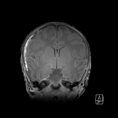 File:Bilateral subdural hemorrhage and parietal skull fracture (Radiopaedia 26058-26190 Coronal T1 24).png