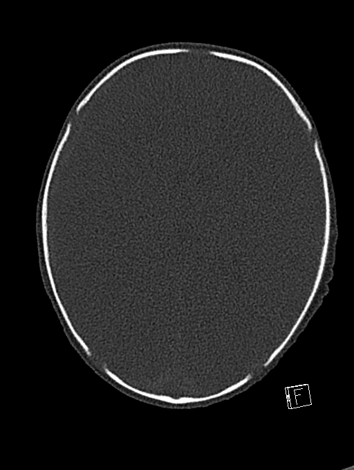Bilateral subdural hemorrhage and parietal skull fracture (Radiopaedia 26058-26192 Axial bone window 55).png