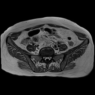 Bilateral tubo-ovarian abscesses (Radiopaedia 58635-65829 Axial T1 C+ 8).jpg