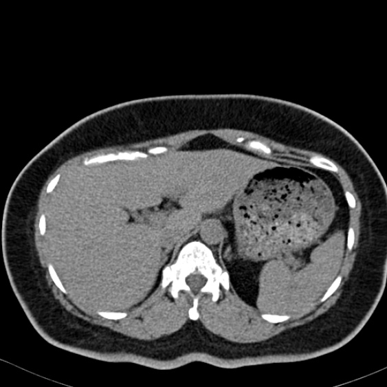 Bilateral ureteric stents (Radiopaedia 48795-53825 Axial non-contrast 10).jpg