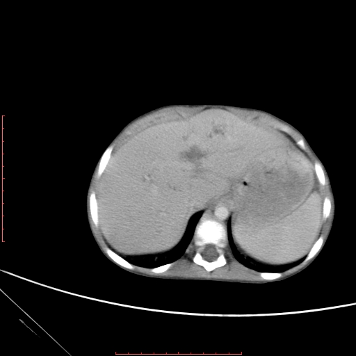 Biliary tract embryonal rhabdomyosarcoma (Radiopaedia 51815-57648 A 11).jpg