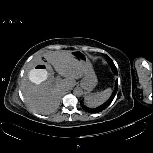 File:Biloma with drainage into the colon (Radiopaedia 20032-20068 B 1).jpg