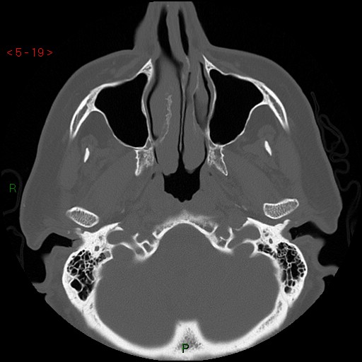 Bisphosphonate-related osteonecrosis of the jaw (Radiopaedia 54147-60329 Axial bone window 13).jpg