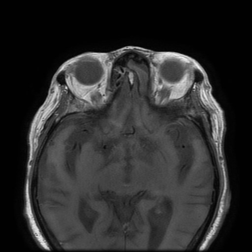 Bisphosphonate-related osteonecrosis of the maxilla (Radiopaedia 51367-57101 Axial T1 43).jpg