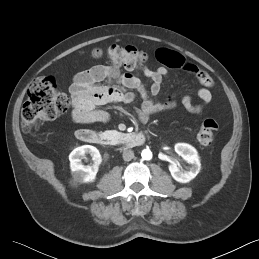 File:Bladder papillary urothelial carcinoma (Radiopaedia 48119-52951 A 24).png