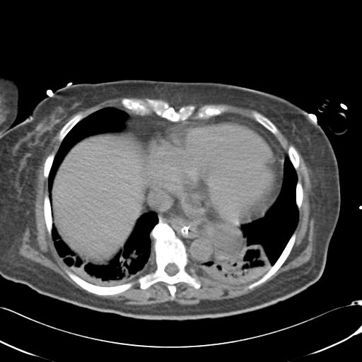 Bladder rupture post renal biopsy (Radiopaedia 30863-31572 Axial non-contrast 8).jpg