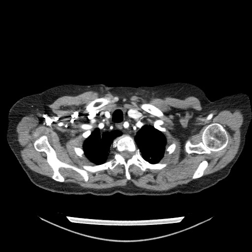 File:Bladder tumor detected on trauma CT (Radiopaedia 51809-57609 A 15).jpg