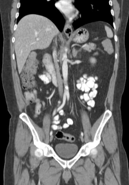 Bleeding duodenal ulcer and adenomyomatosis of gallbladder (Radiopaedia 61834-69861 B 42).jpg