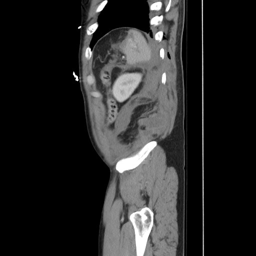 File:Blunt abdominal trauma with solid organ and musculoskelatal injury with active extravasation (Radiopaedia 68364-77895 C 122).jpg