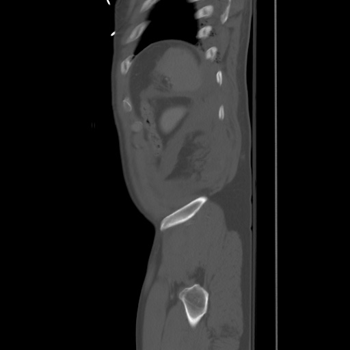 Blunt abdominal trauma with solid organ and musculoskelatal injury with active extravasation (Radiopaedia 68364-77895 Sagittal bone window 100).jpg