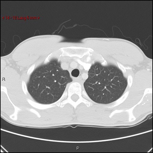 Blunt chest trauma - pulmonary interstitial emphysema and pneumomediastinum (Radiopaedia 20666-20552 Axial lung window 12).jpg