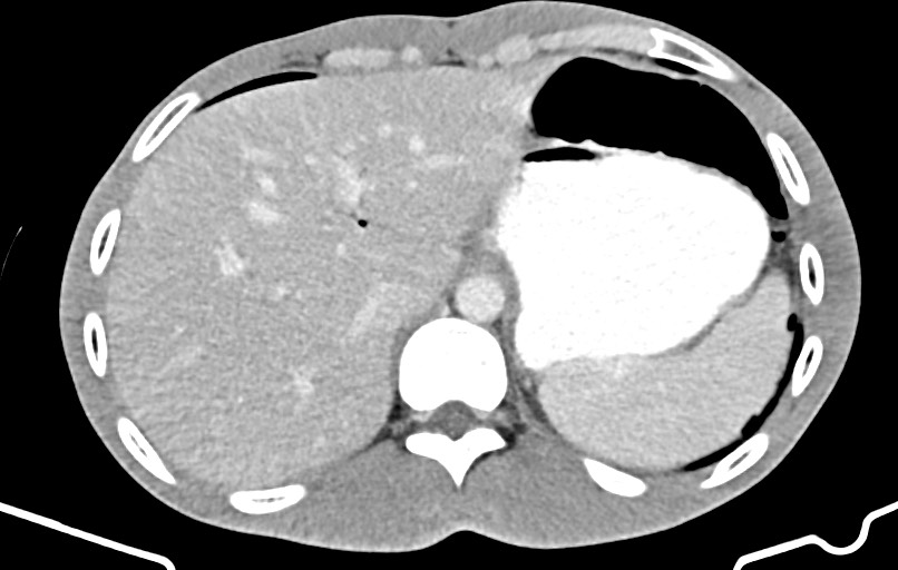 Blunt injury to the small bowel (Radiopaedia 74953-85987 A 17).jpg