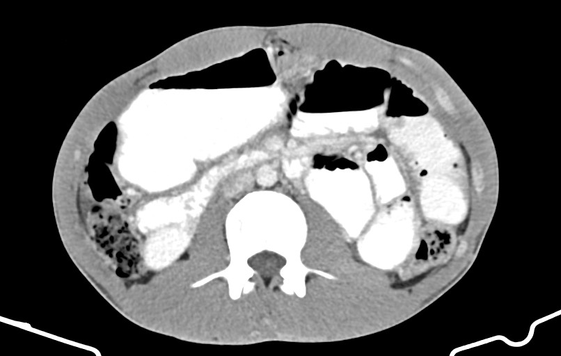 Blunt injury to the small bowel (Radiopaedia 74953-85987 A 77).jpg