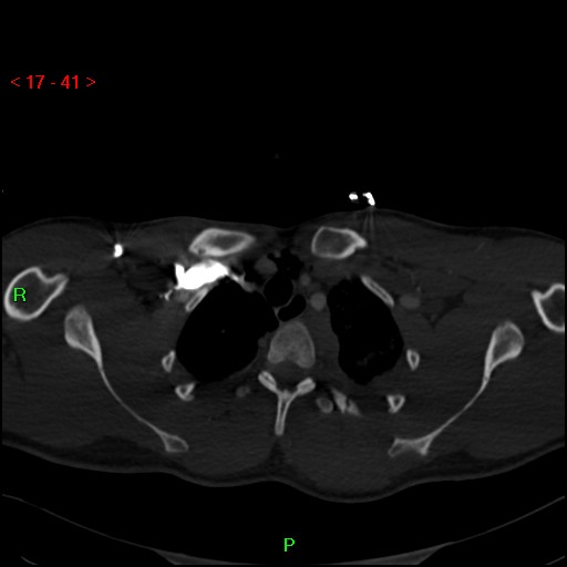 Blunt thoracic trauma (Radiopaedia 73454-84221 Axial bone window 16).jpg