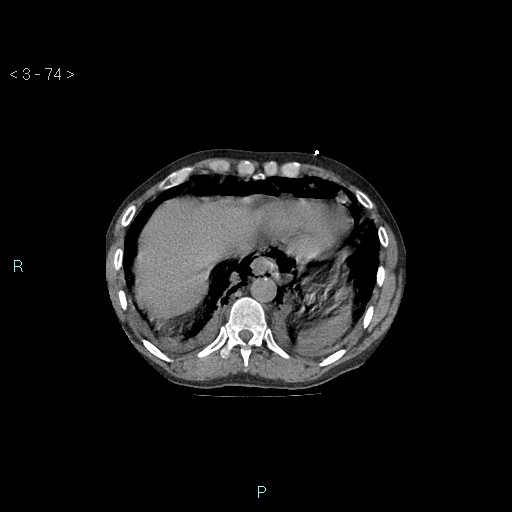 File:Boerhaave syndrome (Radiopaedia 27683-27897 Axial non-contrast 74).jpg