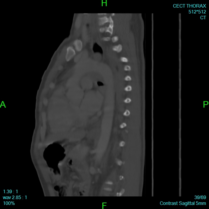 Bone metastases from lung carcinoma (Radiopaedia 54703-60937 Sagittal bone window 39).jpg