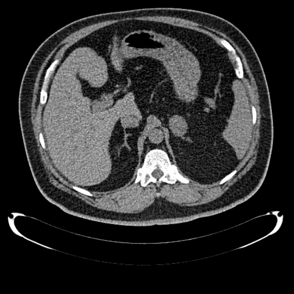 File:Bosniak renal cyst - type IV (Radiopaedia 24244-24518 Axial non-contrast 115).jpg