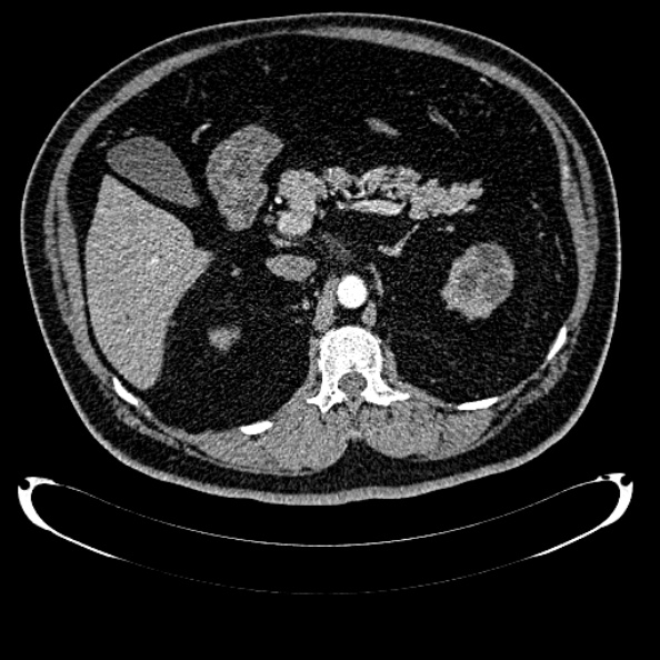 File:Bosniak renal cyst - type IV (Radiopaedia 24244-24518 B 108).jpg