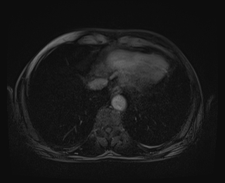 File:Bouveret syndrome (Radiopaedia 61017-68856 Axial T1 C+ fat sat 4).jpg