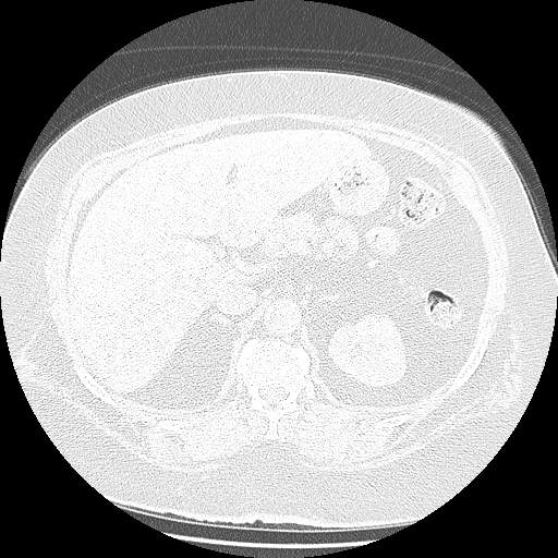 Bovine aortic arch - right internal mammary vein drains into the superior vena cava (Radiopaedia 63296-71875 Axial lung window 191).jpg