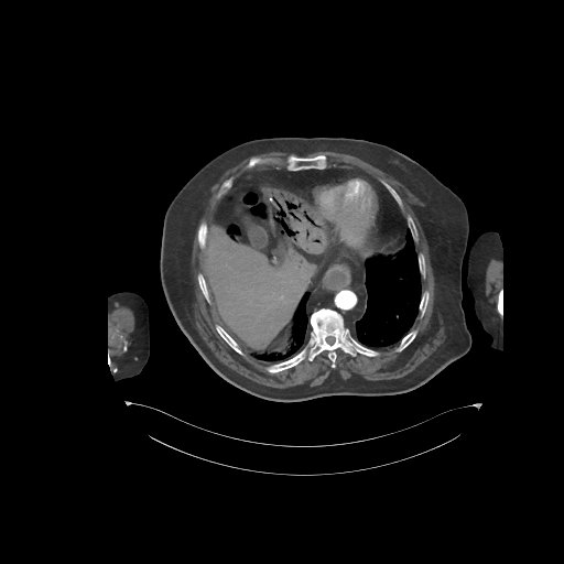 File:Bowel ischemia secondary to SMA occlusion with extensive portomesenteric venous gas (Radiopaedia 54656-60871 A 67).jpg