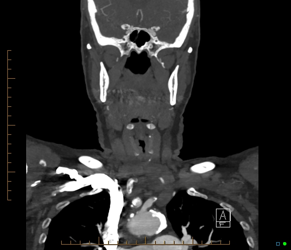 Brachiocephalic trunk stenosis (Radiopaedia 87242-103519 B 28).jpg