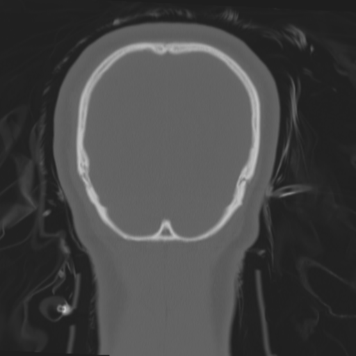 File:Brain contusions, internal carotid artery dissection and base of skull fracture (Radiopaedia 34089-35339 Coronal bone window 61).png
