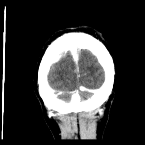 Brain metastases from lung cancer (Radiopaedia 24480-24781 Coronal C+ delayed 58).jpg
