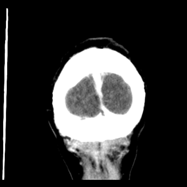 Brain metastases from lung cancer (Radiopaedia 24480-24781 Coronal C+ delayed 59).jpg