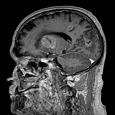 Brain metastases from lung cancer (Radiopaedia 83839-99028 Sagittal T1 C+ 25).jpg
